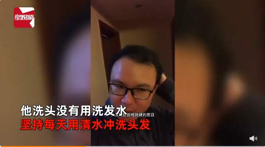 男子禿頂半個(gè)月不用洗發(fā)水后長(zhǎng)出頭發(fā) 他個(gè)人認(rèn)為洗發(fā)水對(duì)頭發(fā)傷害很大