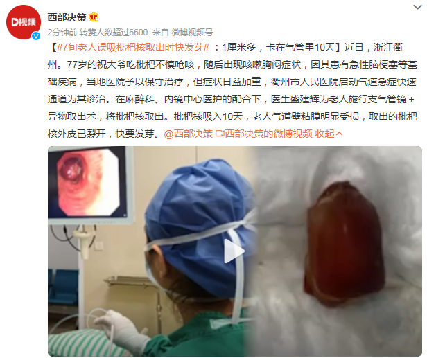7旬老人誤吸枇杷核取出時(shí)快發(fā)芽 海姆立克急救法關(guān)鍵時(shí)刻能救命