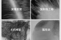 脫發(fā)人群基數(shù)龐大 30歲以下占近70% 市場規(guī)模年增長率超10%