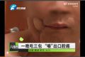 大巴司機(jī)吃檳榔1年查出口腔癌 檳榔有哪些危害?